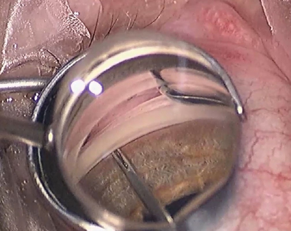 Placement of iStent inject perpendicular to the trabecular meshwork.