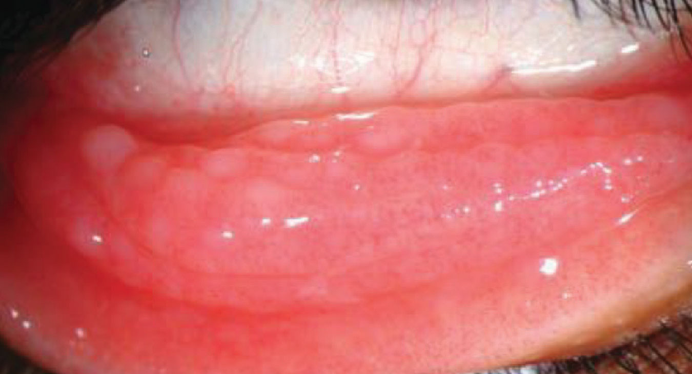 VKC is a more severe form of conjunctivitis and is most likely allergic in origin.