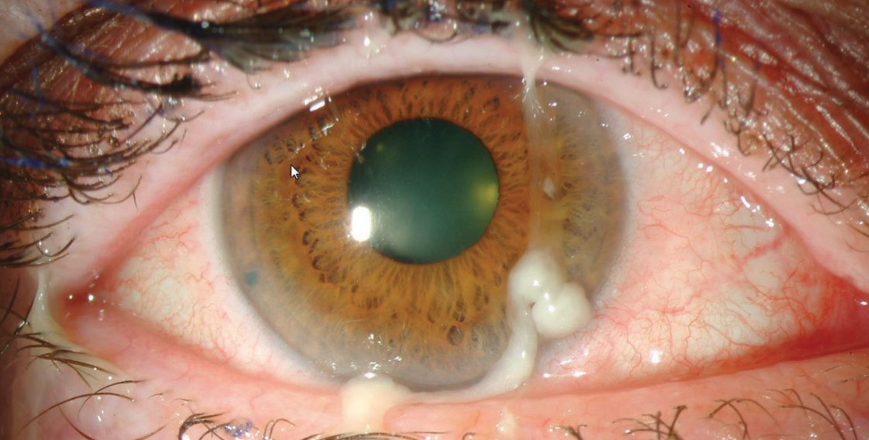 Bacterial conjunctivitis is often a byproduct of the natural flora of the individual and is most commonly caused by Staphylococcus aureus, Streptococcus pneumonia and Haemophilus.