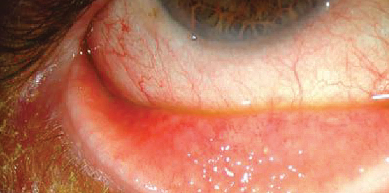 Adult inclusion conjunctivitis is caused by Chlamydia trachomatis and has an incubation period of two to 19 days. Most patients have a unilateral mucopurulent discharge, as well as a follicular and hyperemic tarsal conjunctiva response.