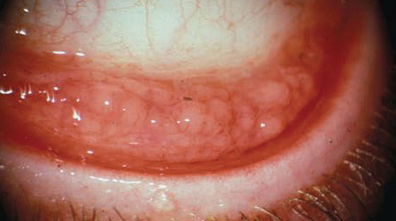 Allergic conjunctivitis is due to a type one hypersensitivity reaction to a specific antigen.