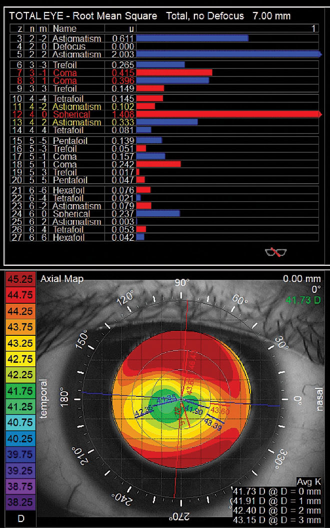 Higher-order aberrations measured after orthokeratology lens wear. Primary coma and spherical aberration are elevated to outside normal limits. Corneal topography shows central flattening with an incomplete treatment ring.