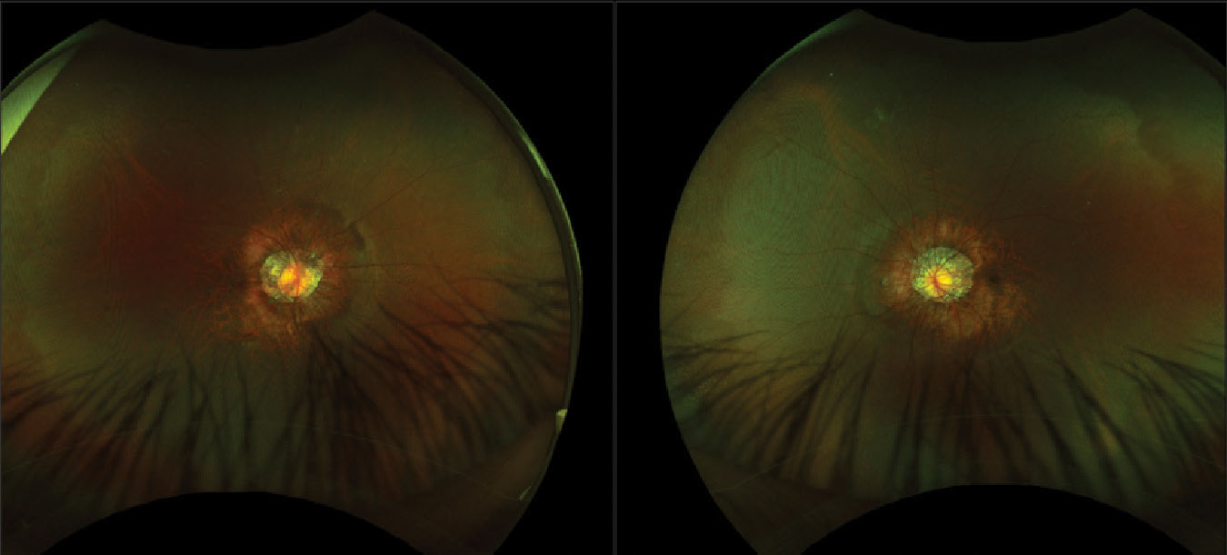 Fundus photos of the right and left eyes show posterior staphylomas, common among high myopes, with peripapillary atrophy around the optic nerve heads. White without pressure can be seen in the periphery of both eyes.