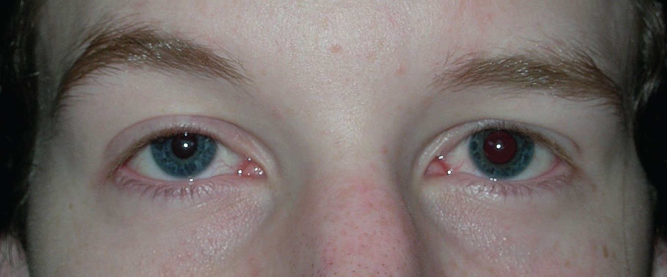 Fig. 11. Right Horner syndrome. The right pupil is smaller compared with the left, there is ptosis of the right eyelid and the right iris is of lighter color compared with the left iris.