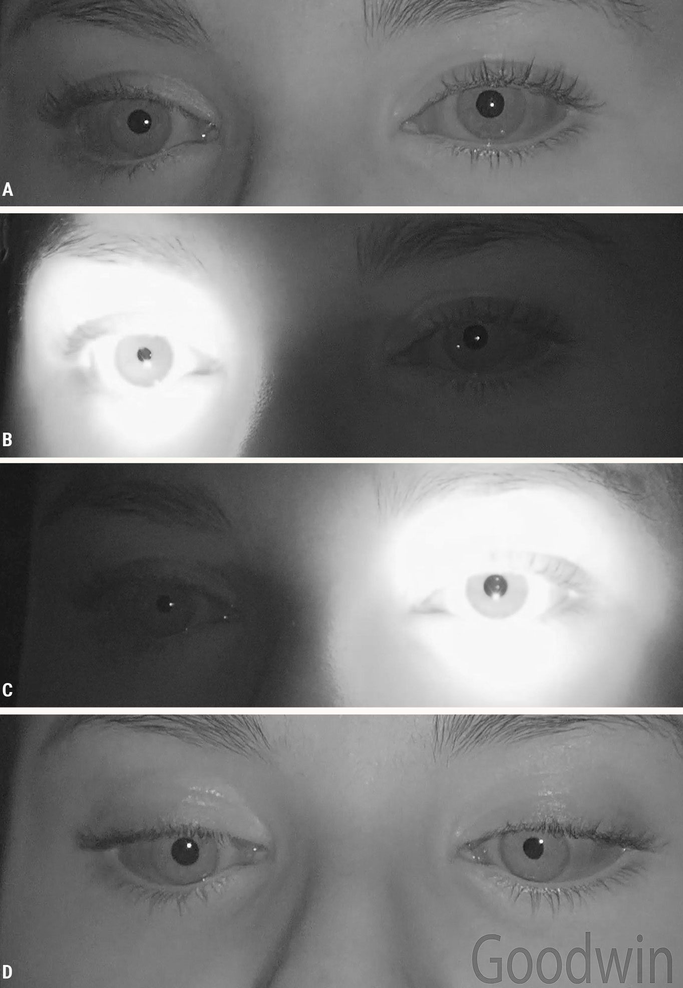 Fig. 5. A left tonic pupil: (A) There is slight anisocoria in dim illumination. (B) The normal right pupil is responsive to light. (C) The tonic left pupil is not responsive to light. When light is shined in the eye the amount of anisocoria is greater. (D) Both eyes constrict to a near target, although the left eye takes longer to constrict maximally.