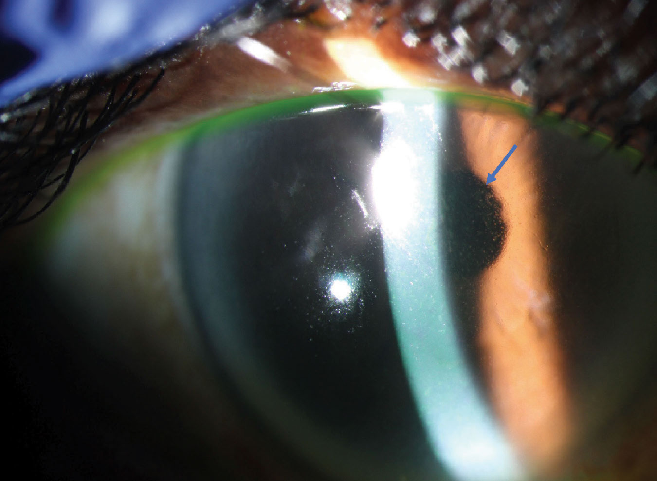 Fig. 1. Corneal MECs (blue arrow) in a patient with ADC-related keratopathy.