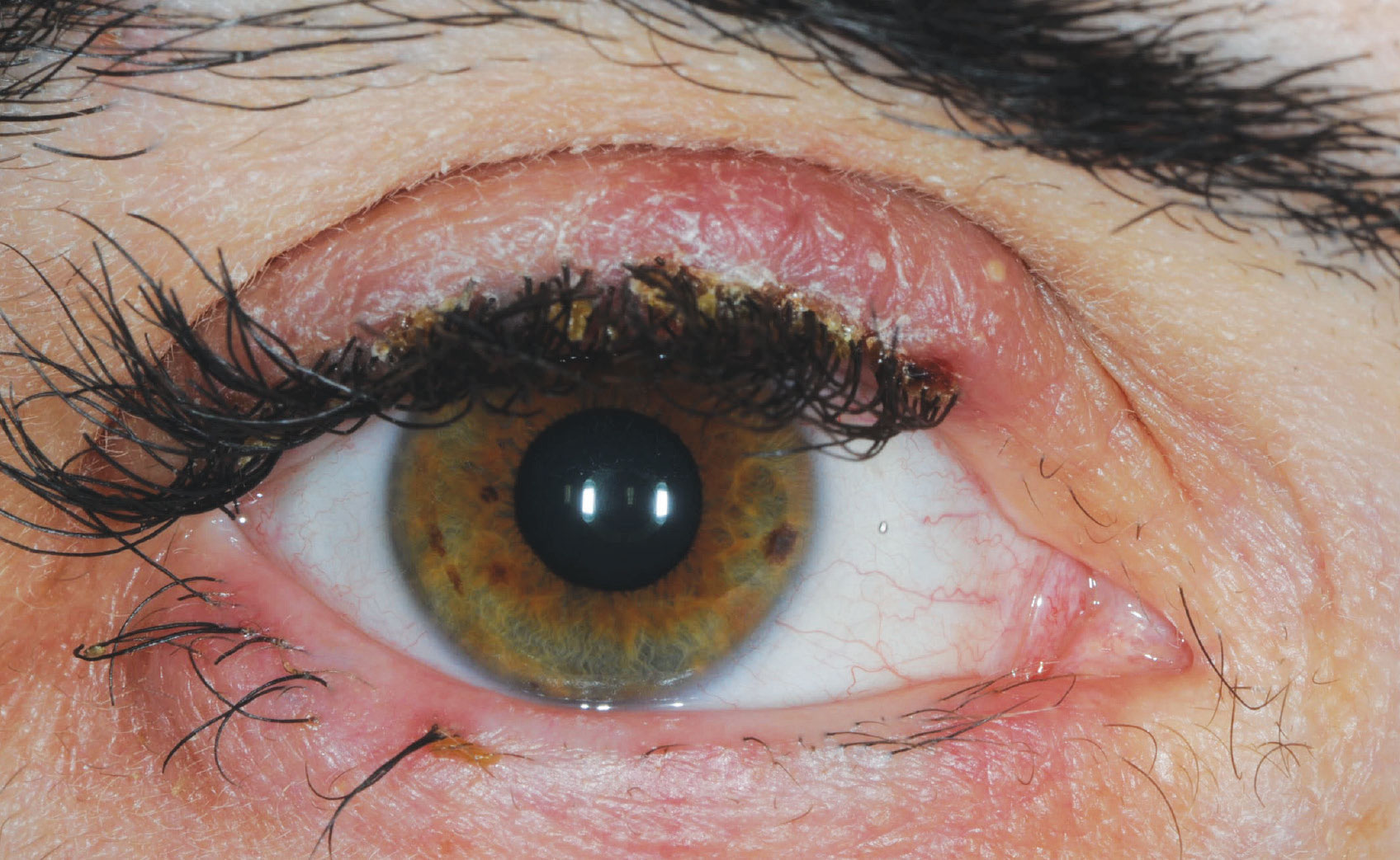 Fig. 3. Blepharitis and trichomegaly in a patient treated with an EGFR inhibitor.