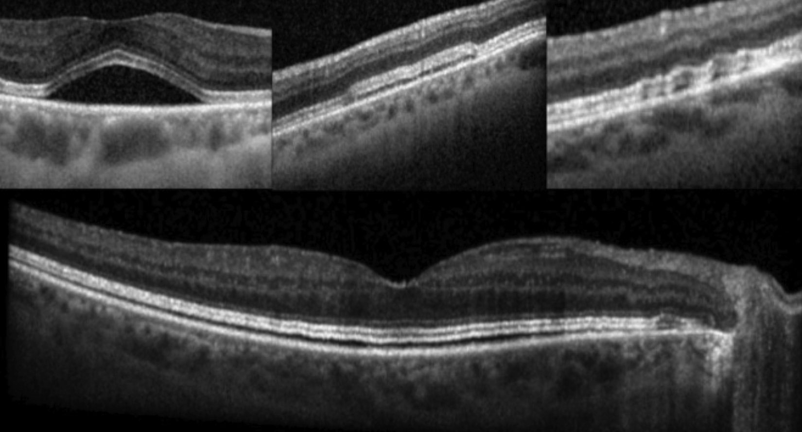 Fig. 4. OCT reveals fluid between the interdigitation zone and retinal pigment epithelium in varying configurations in patients with MEKAR.