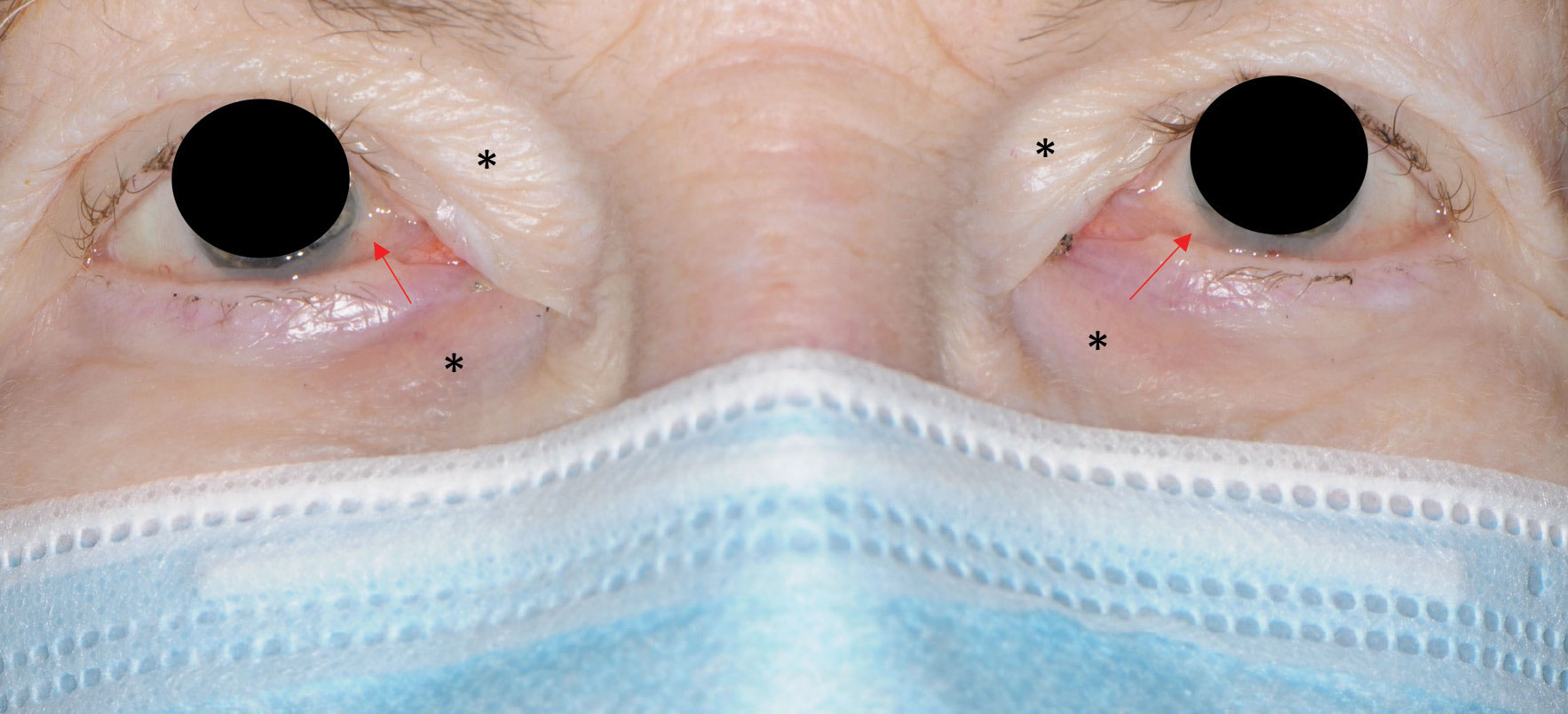 Fig. 5. Periorbital edema (black asterisks) and conjunctival chalasis (red arrows) in a patient on Gleevec.