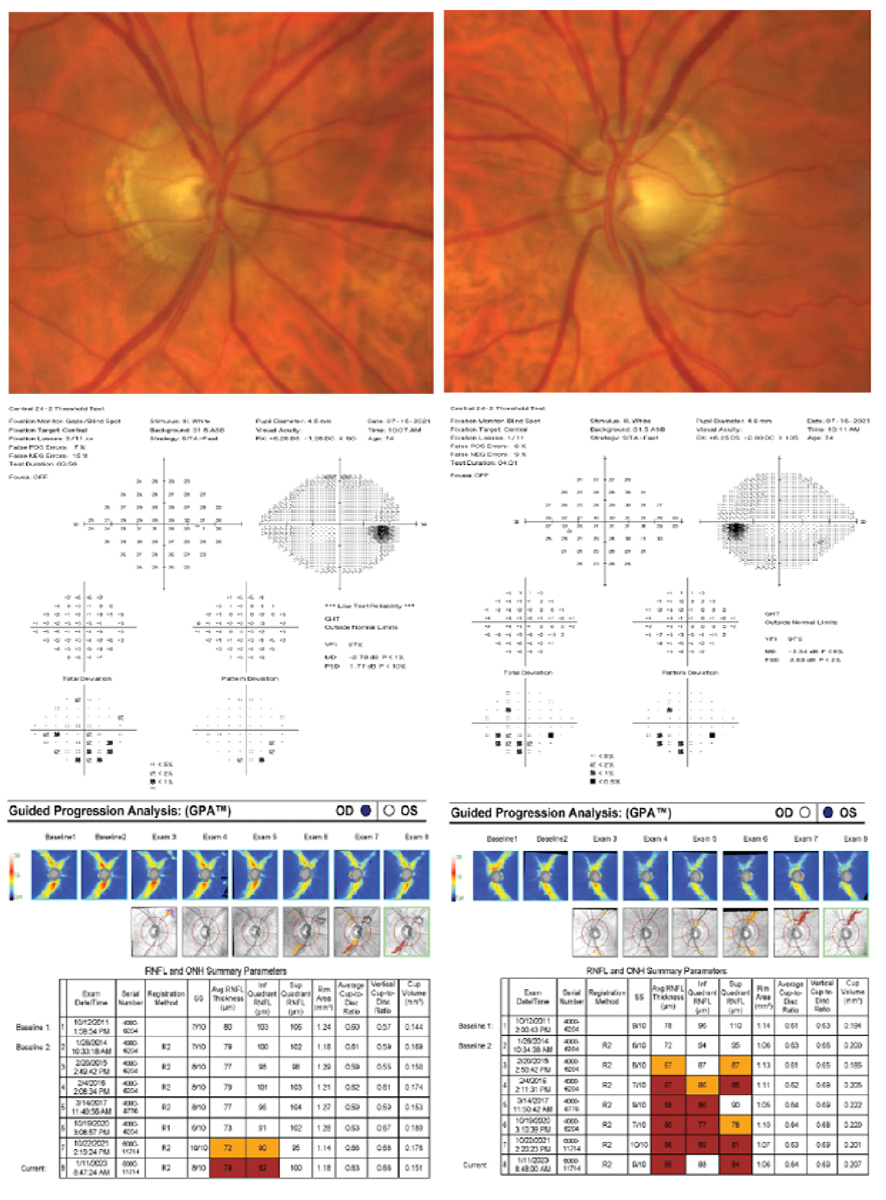 A 75-year-old white, non-Hispanic male presented with an initial history of OHT, but years of non-compliant follow-up and medication use resulted in accelerated loss of the RNFL and ultimate conversion to POAG. His untreated IOP max was 28mm Hg in both eyes, pachymetry measured 527µm OD and 529µm OS, VCDR was 0.60 OD and 0.70 OS and PSD was 1.77 OD and 2.53 OS. His visual fields were variable in both eyes. His RNFL showed accelerated and repeatable loss OS>OD. His deviation maps showed a widening wedge defect strongly correlated with glaucomatous RNFL loss. Based on these high-risk factors, medication and selective laser trabeculoplasty (SLT) were recommended at the time of diagnosis. The patient declined and experienced both structural and functional damage. Luckily, over the last three years with SLT and compliant topical prostaglandin analog use, his treated IOPs were lowered by 50%. This ultimately preserved his visual function without sustainable severe glaucomatous defects. Due to his general health status and anticipated life expectancy, he remains at risk for further visual damage if compliance and medication burden remain an issue.