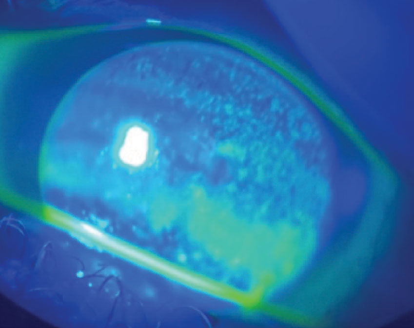 Diffuse sodium fluorescein staining indicative of corneal dryness OS of a patient with a history of chronic inflammatory dacryoadenitis secondary to GPA. 