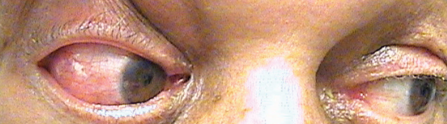 Conjunctival hyperemia in a man with double vision and proptosis.