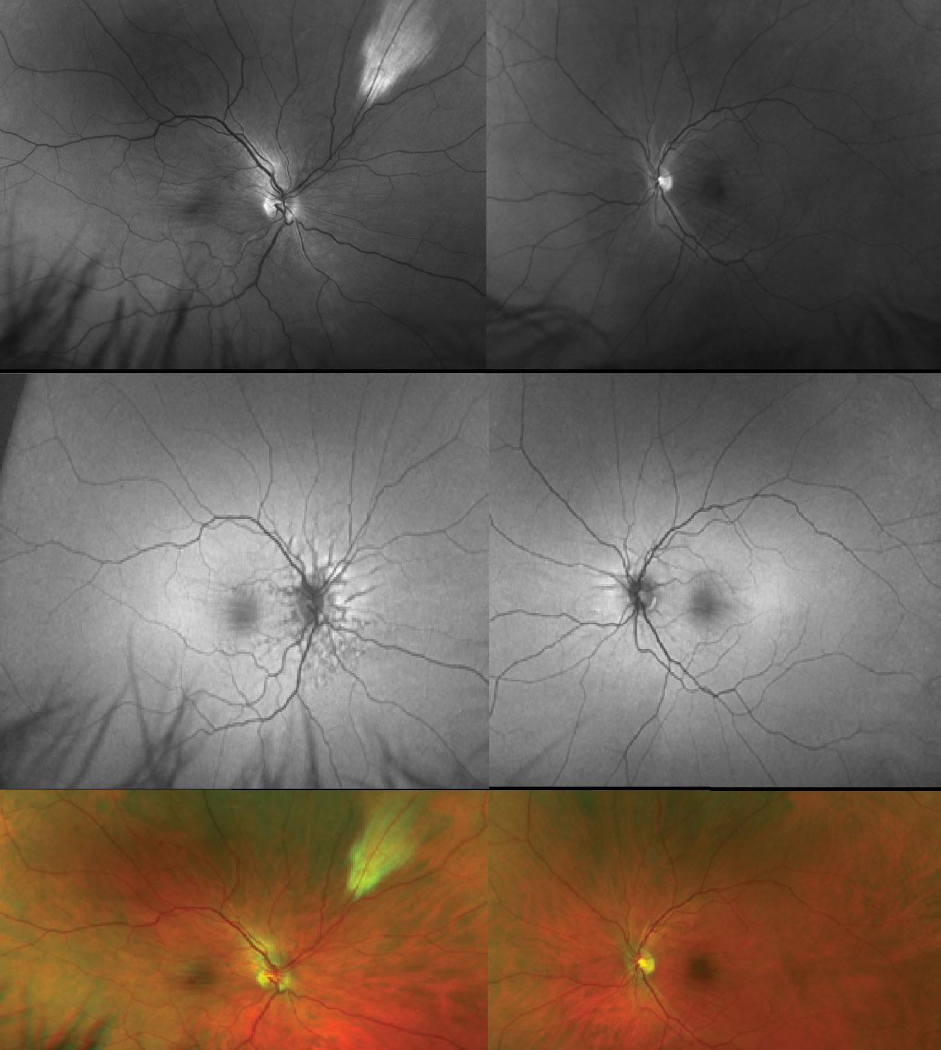 Bilateral choroidal folds radiating from the disc and through the macula with a red-free (green) filter (top), on FAF (middle) and on fundus photos (bottom). Note this patient has angioid streaks around his optic discs OD>OS and myelinated nerve fibers in the superonasal midperiphery OD. 