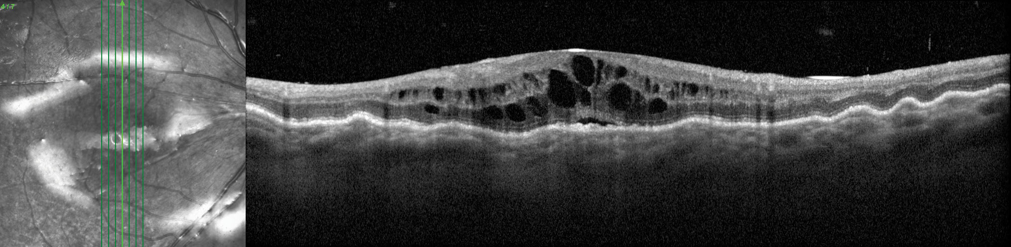 This eye has hypotony maculopathy with choroidal folds, intraretinal and subretinal fluid and optic disc edema. His IOP was generally between 2mm Hg and 5mm Hg. 