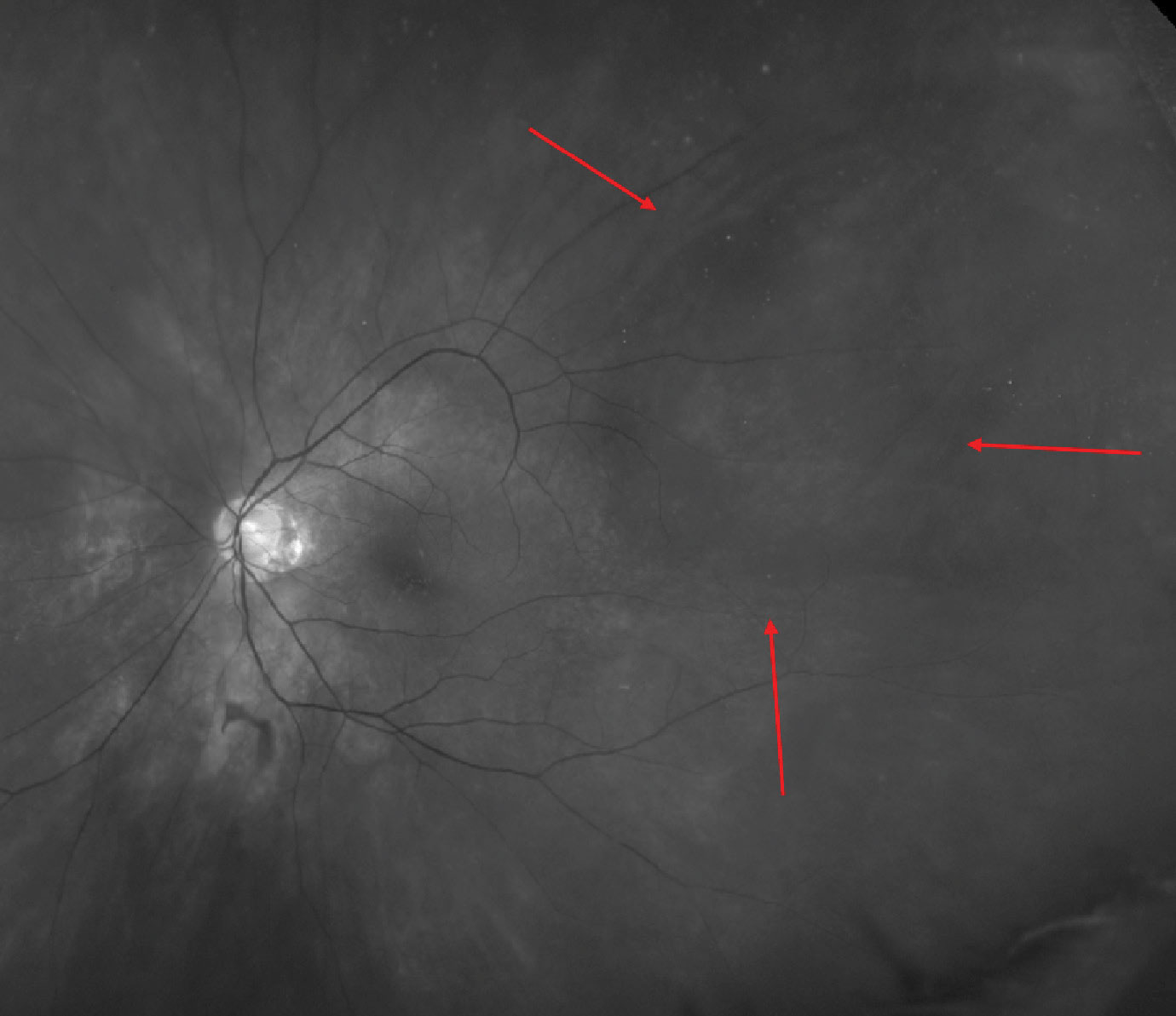 This eye has choroidal folds surrounding a large vortex vein varix, which is more easily visible with a red-free (green) filter.  