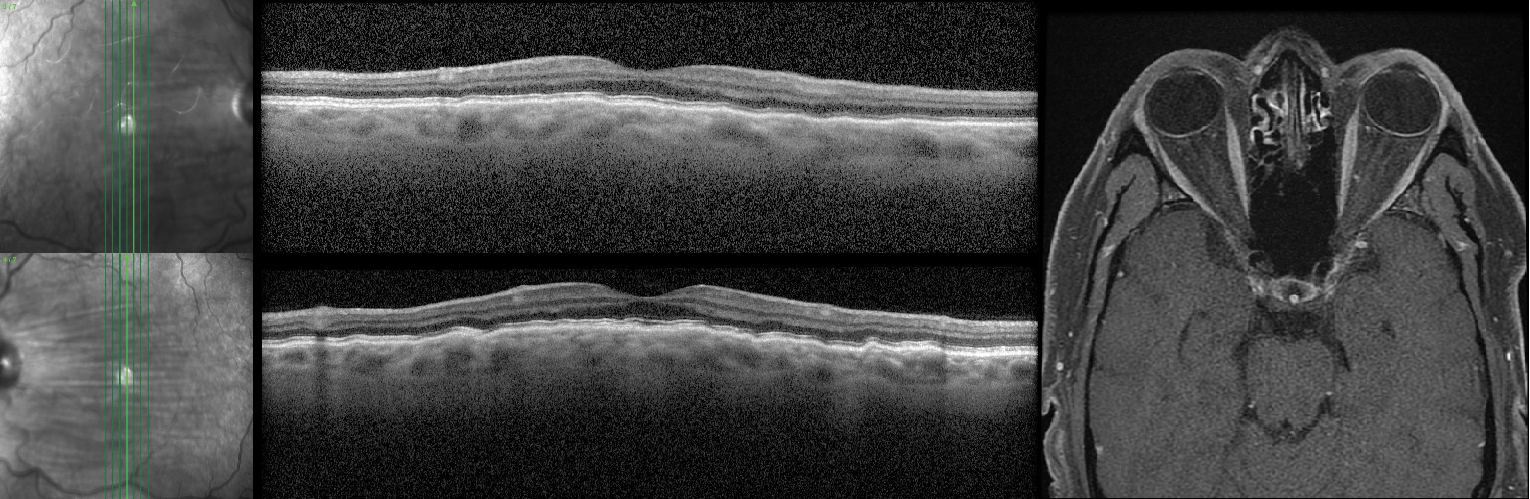 These bilateral choroidal folds OS>OD were found in a male patient in his 40s. He was asymptomatic, moderately hyperopic and had no notable ocular history. His MRI (axial T1) showed posterior globe flattening OD>OS.