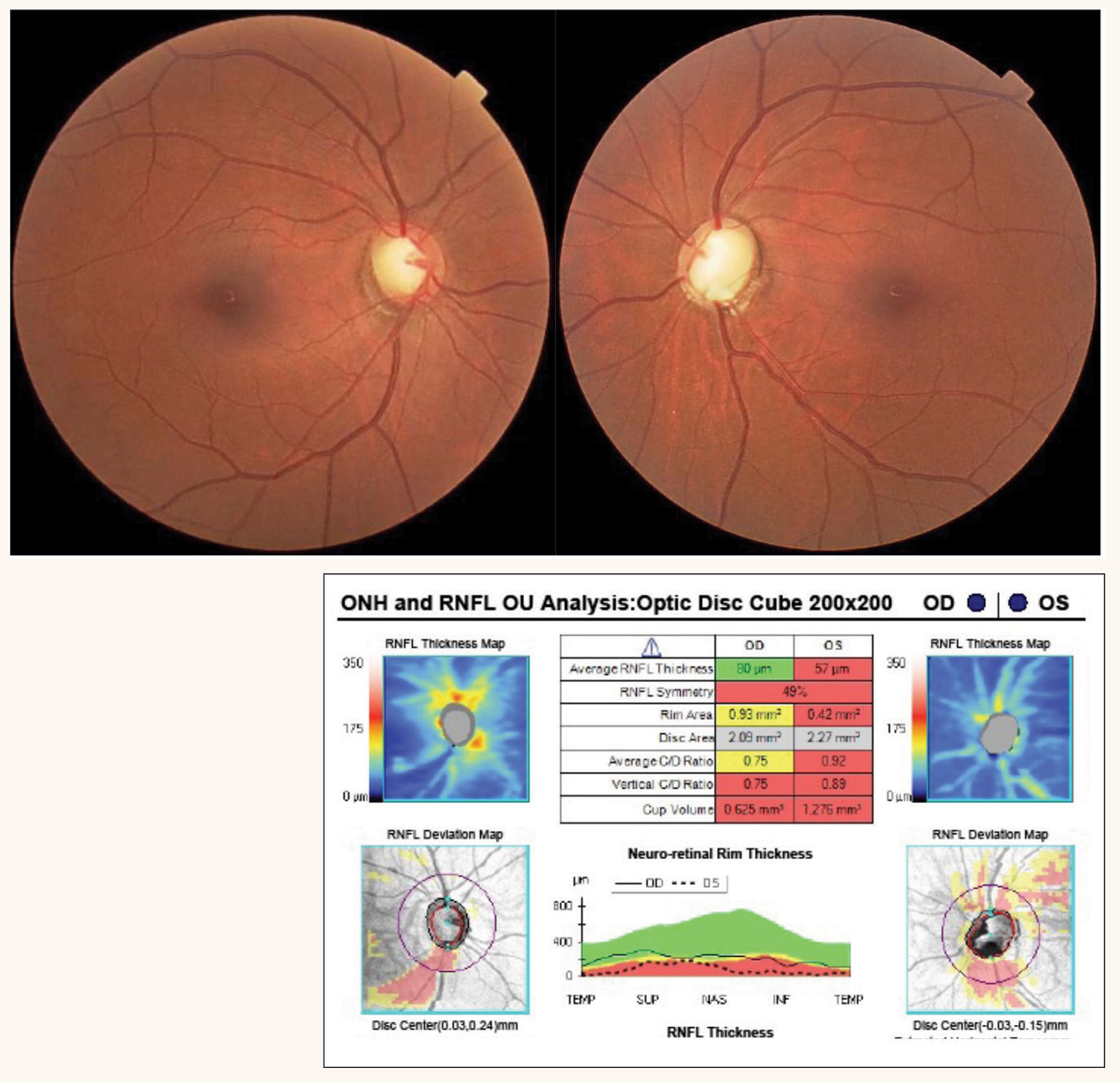 Fig. 1. Tilted discs with RNFL dropout OD and congenital optic pit OS. OCT reveals RNFL defects in the interior quadrant consistent with disc tilt. 