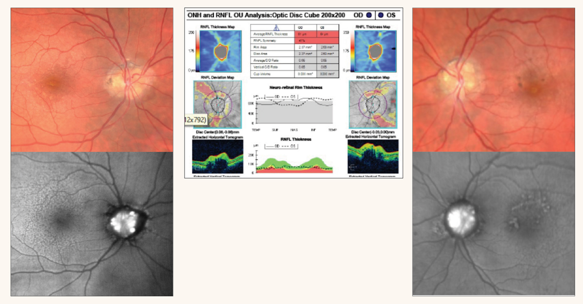 Fig. 2. Color and fundus autofluorescence images of optic disc drusen involving both the right and left eyes. OCT reveals RNFL thinning and elevated optic disc margins.