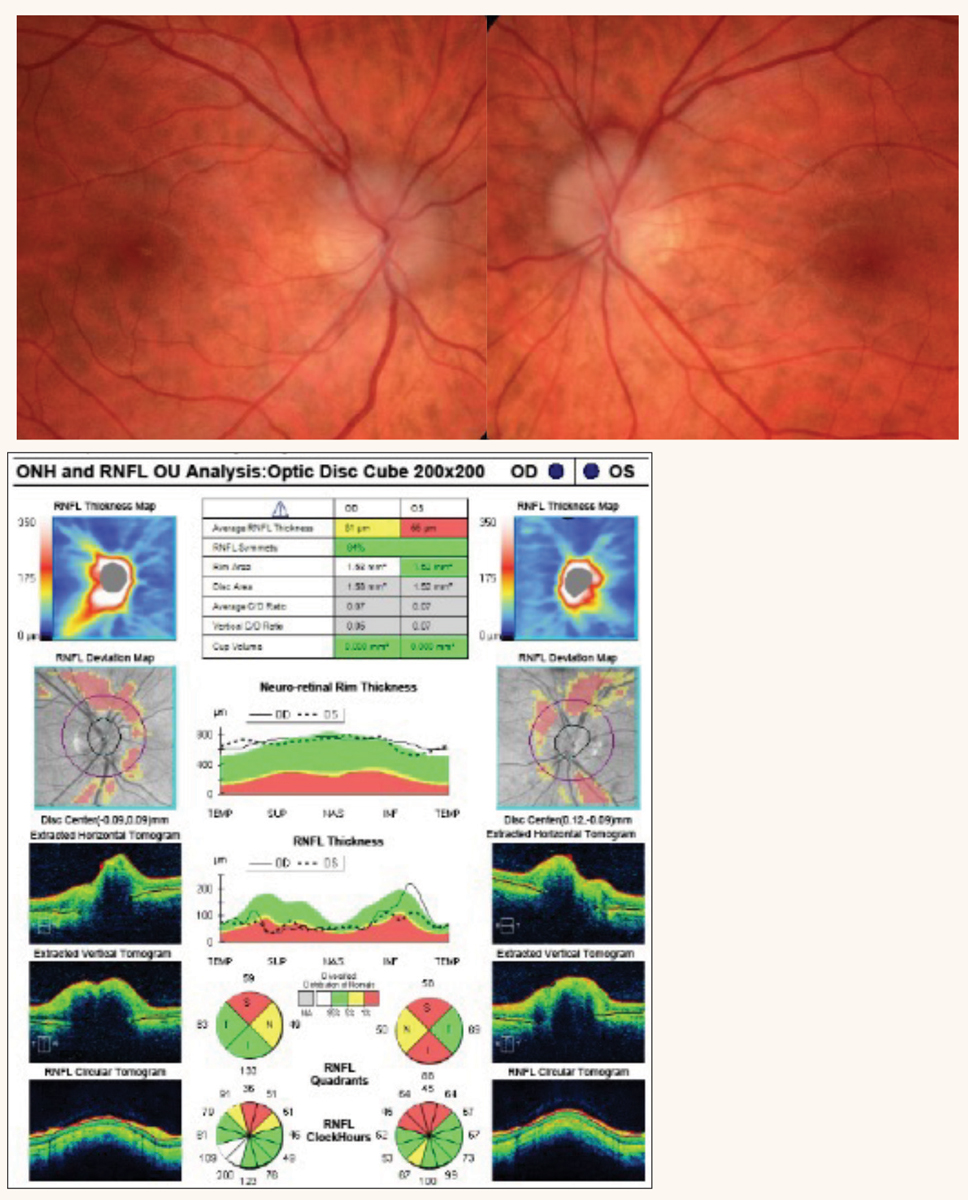 Fig. 5. Bilateral optic disc edema associated with IIH. OCT confirms the presence of optic disc edema and RNFL thinning.