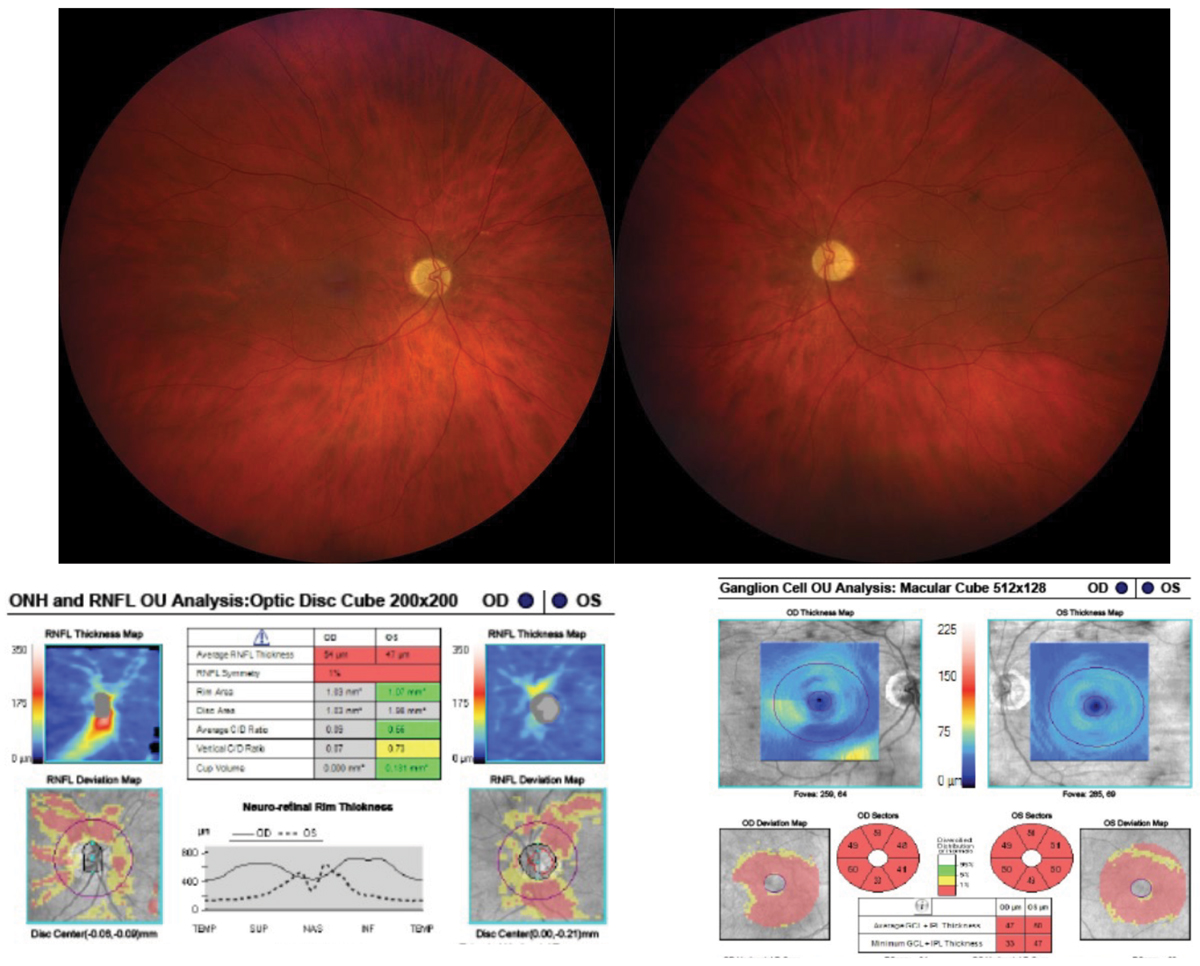 Fig. 7. Bilateral optic disc pallor secondary to toxic optic neuropathy due to rheumatologic medication. Discs are pale, and OCT confirms RNFL and GCC defects.