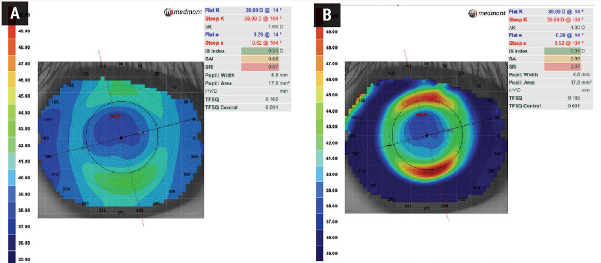 Fig. 5. Axial power map (A) and tangential power map (B) of a patient treated with orthokeratology. The axial map provides data on the corneal astigmatism type and corneal curvature power. A tangential map allows the visualization of the corneal curvature in one place relative to neighboring tangential points. This is most helpful when analyzing orthokeratology lens centration.