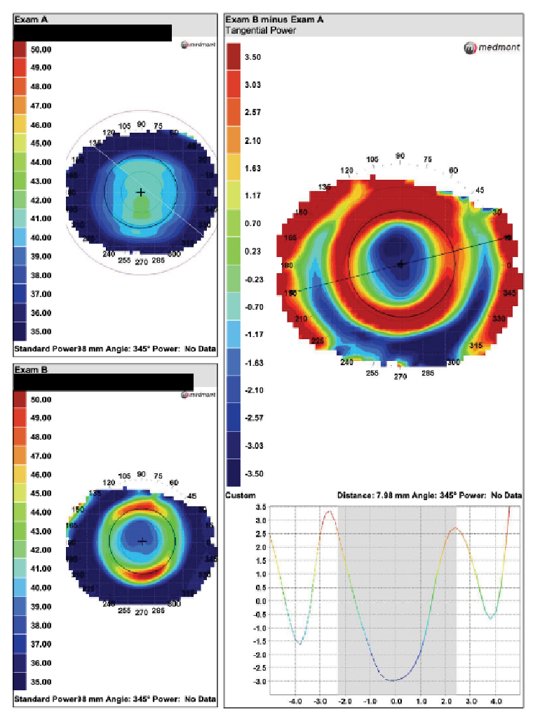 Fig. 6. Comparison of post and pre-wear topography scans to highlight changes in corneal shape caused by orthokeratology lenses. The scale was reset for this -3.50D myope’s tangential difference map. The lens is centered and there is -3.50D of treatment.