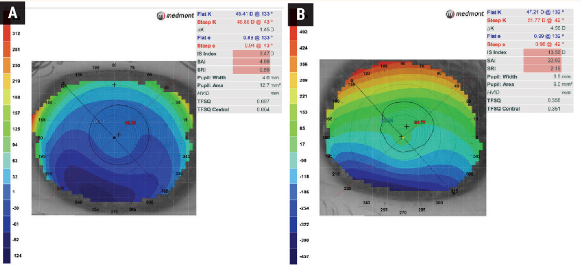 Fig. 8. Elevation maps of two corneas with keratoconus: (A) shows an elevation difference of ~150µm from the highest to lowest elevation point vs. (B) an elevation difference of over 600µm. This suggests that a GP is much more likely to be successful in (A), whereas a scleral lens is more likely to be successful in (B). 