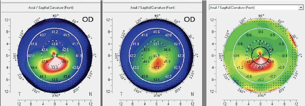 Fig. 9. Scheimpflug-based imaging system to generate an axial map of a 14-year-old female patient who underwent CXL in her right eye. Following a 10-month post-CXL evaluation, the difference map reveals a significant increase of 5D in Kmax, indicating corneal steepening and progression. Consequently, the patient underwent a subsequent round of CXL treatment to enhance corneal stability.