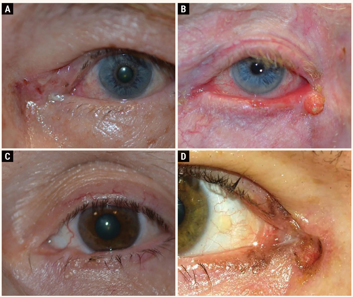 This series shows the range of potential eyelid carcinomas: (A) basal cell carcinoma, (B) nodular squamous cell carcinoma, (C) sebaceous cell carcinoma and (D) melanoma.
