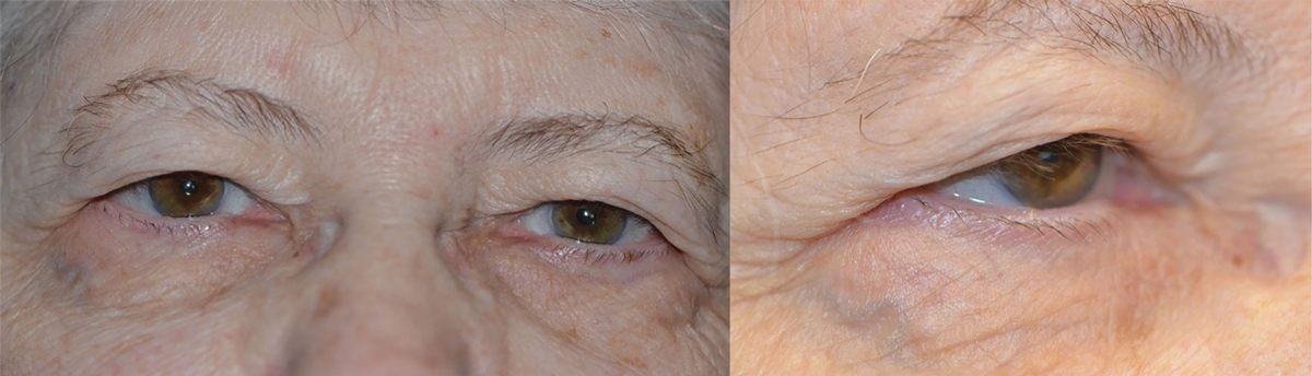 Bilateral upper lid dermatochalasis. The upper lids are resting on the eyelashes, causing downward misdirection.