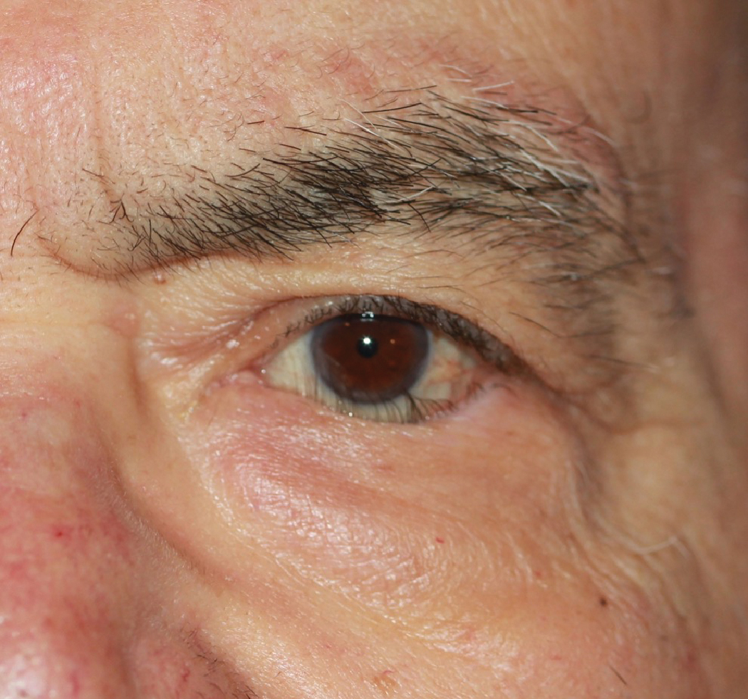 This patient suffers from corneal irritation resulting from trichiasis caused by lower lid entropion.