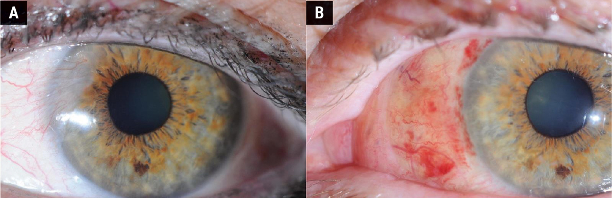 Fig. 4. (A) Before pterygium removal surgery. (B) Three months after surgery.