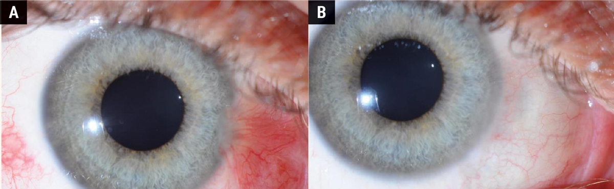Fig. 5. (A) Before pterygium removal surgery. (B) A fully healed sclera one year after surgery.
