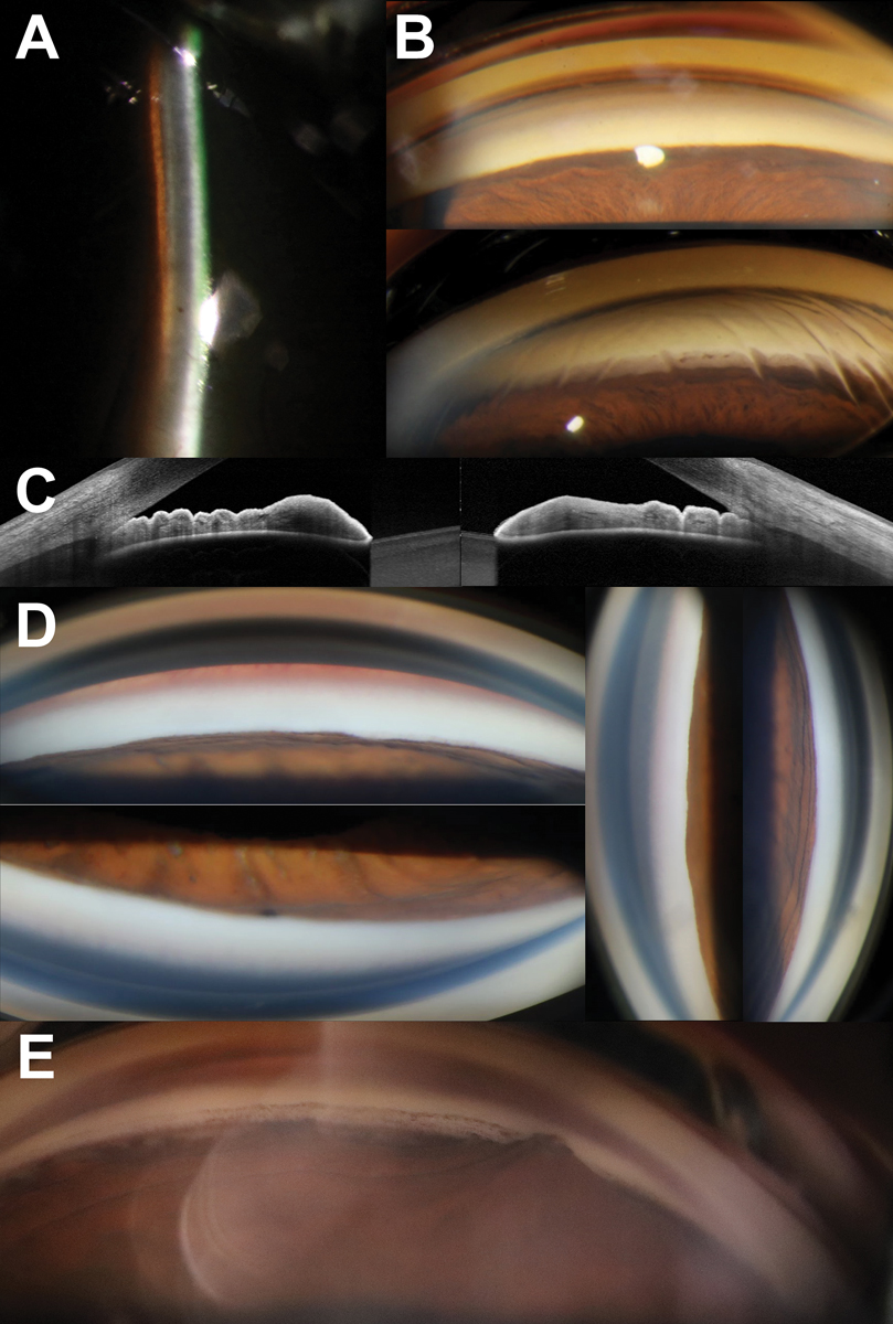 Fig. 1. (A) Narrow van Herick angle estimation of 0.1:1. (B) Gonioscopy with no angles visible in primary gaze without indentation (top) with deepening as well as increased visibility of angle structures with associated corneal stress lines on indentation (bottom). (C) Obvious iridotrabecular contact in both nasal and temporal angles on anterior segment OCT. (D) No visible structures in all quadrants in a patient with an acute angle closure attack. (E) Focal peripheral anterior synechiae in a patient with a history of an acute angle closure attack following clear lens extraction.