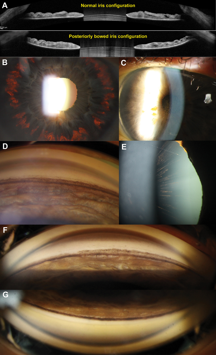 Fig. 2. (A) AS-OCT of a normal (top) and posteriorly bowed iris configuration in a patient with PDS (bottom) with contact between the mid-peripheral iris and anterior lens surface. (B) Retroillumination technique highlights mid-peripheral iris transillumination defects. (C) Endothelial pigment deposition (also known as Krukenberg’s spindle). The flow of aqueous convection currents results in denser central deposition, which gives rise to the spindle-like pattern. (D) Dense homogenous increased pigmentation within the angle, particularly along the trabecular meshwork and anterior to Schwalbe’s line (also known as Sampaolesi’s line). In active PDS, all four quadrants will have a similar extent of pigmentation. There is also posterior bowing of the iris profile. (E) Long anterior lens zonules (LAZs) with associated pigmentation. In PDS, the anterior lens zonules are more centrally located on the lens capsule and often appear pigmented due to contact with the posterior iris surface. (F) An example of “pigment reversal sign” in burnt out PDS, where the inferior angle appears less densely pigmented (top) compared with the superior angle (bottom). This is considered to be a sign of inactive disease.