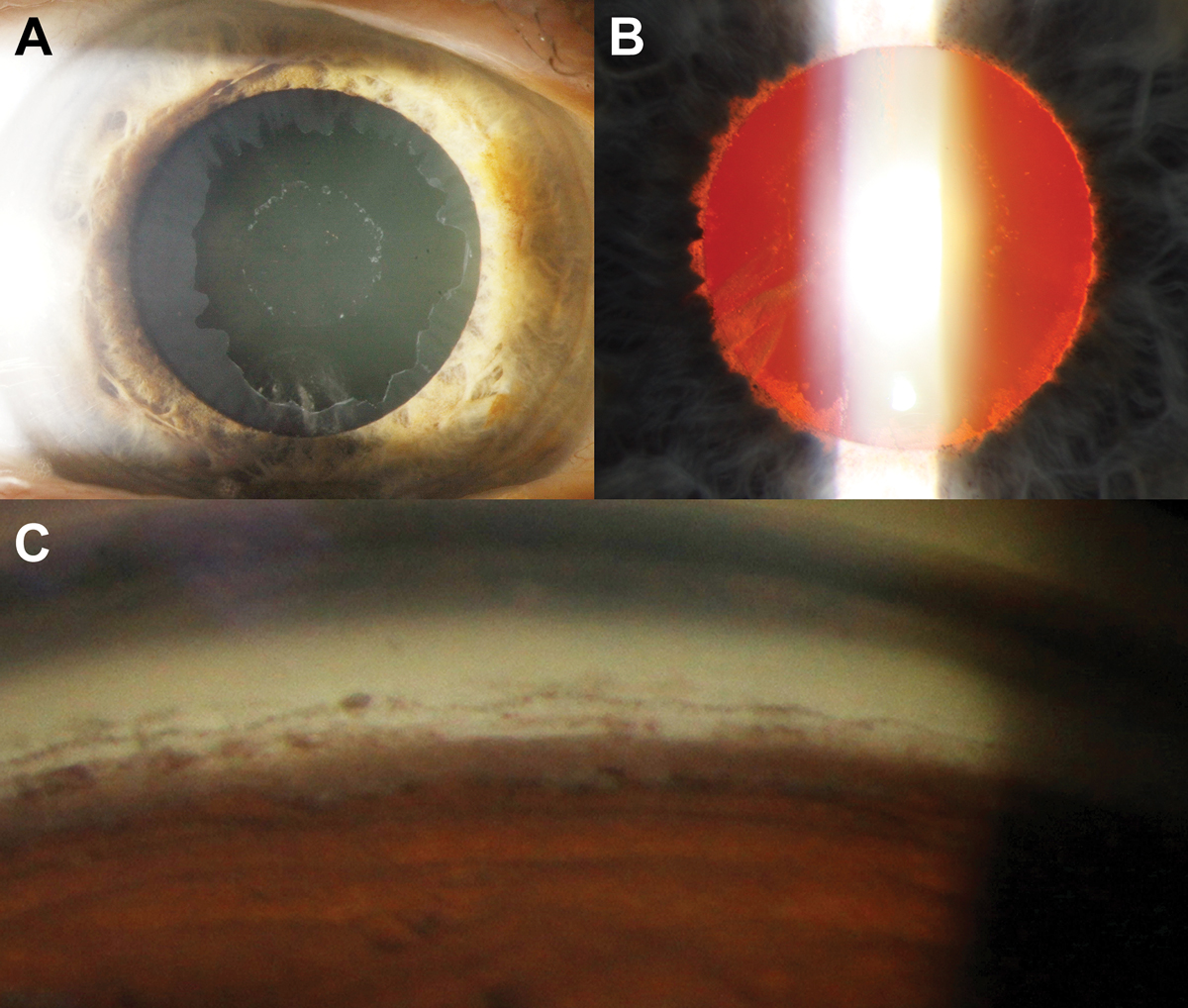 Fig. 3. (A) Bull’s-eye pattern of pseudoexfoliative material on the anterior lens capsule. (B) Retroillumination shows loss of the pupillary ruff as well as peripupillary iris transillumination defects. (C) There is increased but patchy pigmentation (brown sugar-like appearance) of the trabecular meshwork on gonioscopy as well as Sampaolesi’s line. The inferior angle typically appears more pigmented compared with the other angles.