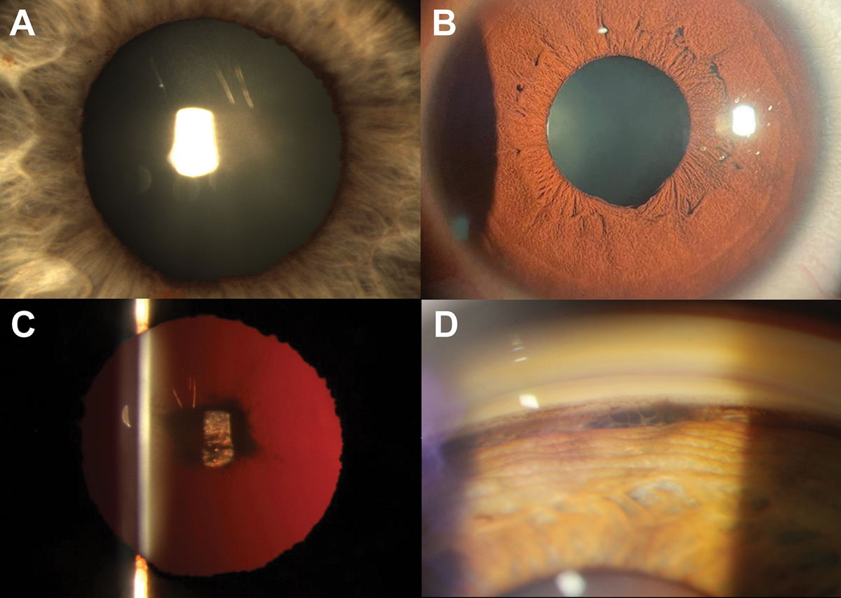 Fig. 4. (A) Nasal loss of the pupillary ruff in a patient with a history of blunt trauma to the eye. (B) Focal traumatic mydriasis between five and six o’clock suggest iris sphincter damage in this location. (C) Traumatic cataract with a petaloid pattern seen with retro illumination. (D) Focal widening of the ciliary body band observed in the superior mirror on gonioscopy.