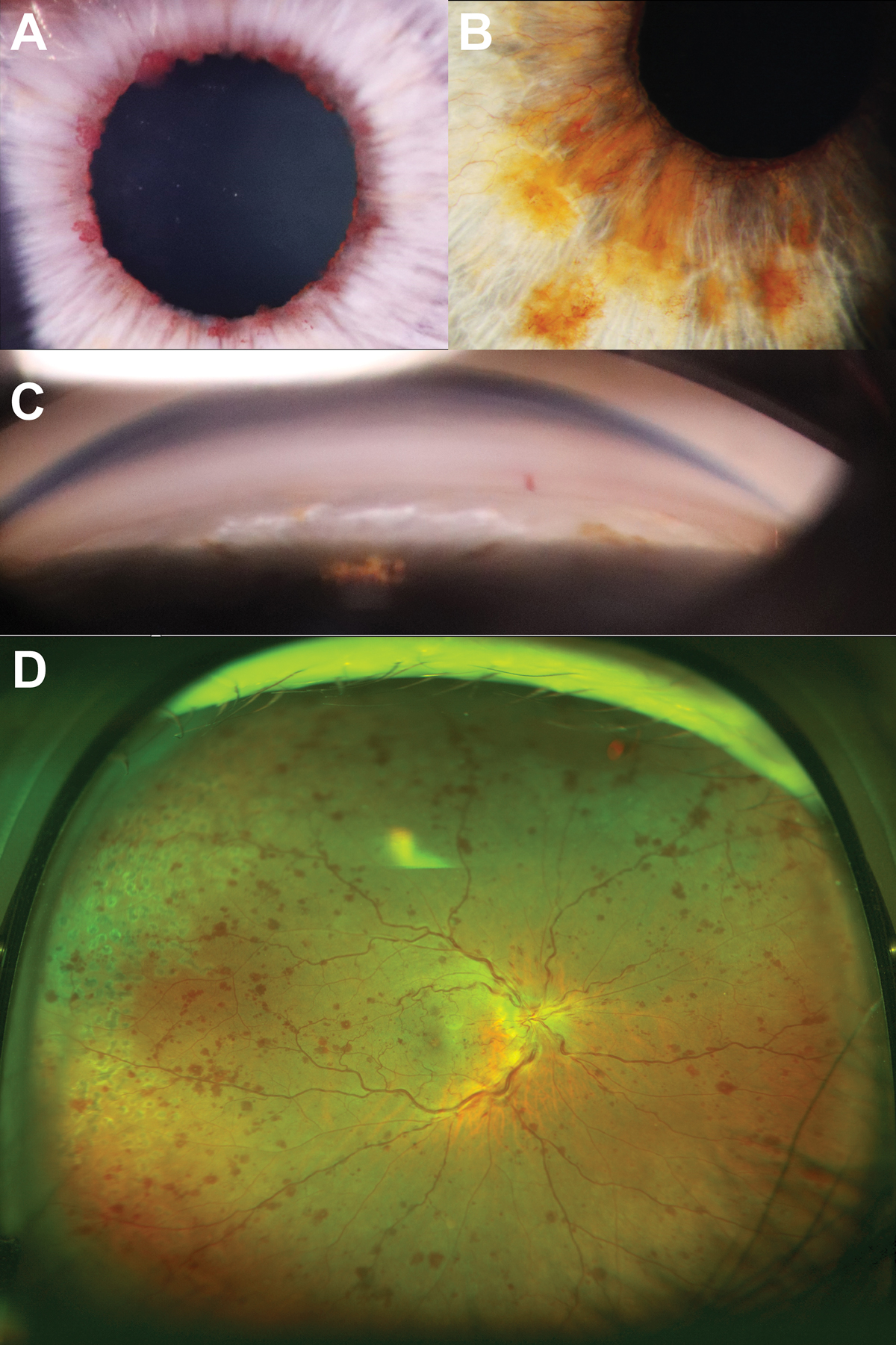 Fig. 5. (A) Tuft-like neovascularization along the pupillary margin. (B) Proliferation of the iris neovascularization from the across the anterior iris surface. (C) Neovascularization seen within the angle on gonioscopy. (D) Ultra-widefield imaging of the active central retinal vein occlusion in the right eye from the patient shown in B and C.