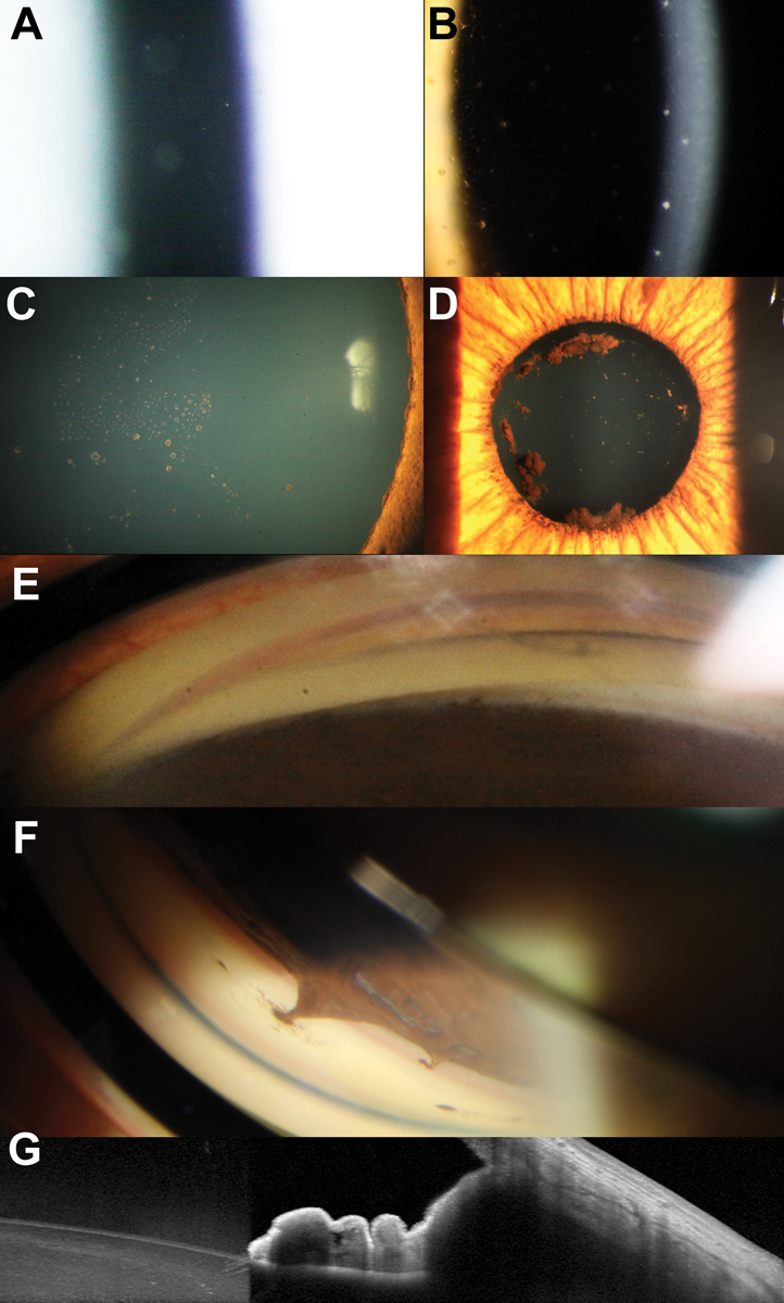 Fig. 6. (A) Assessment of the anterior chamber shows anterior chamber cells. (B) Keratic precipitates and pigment on the corneal endothelium. (C) Multifocal pigmentation on the anterior lens surface in a patient with recurrent uveitis. (D) Larger agglomerates of pigment on the anterior lens capsule suggestive of broken posterior synechiae. (E) Broad peripheral anterior synechiae manifesting with narrowing of the angle in the left side of the image. (F) Focal peripheral anterior synechiae adjacent to an area of iris atrophy. (G) AS-OCT through an area of peripheral anterior synechiae showing anterior displacement of the peripheral iris resulting in iridotrabecular contact.