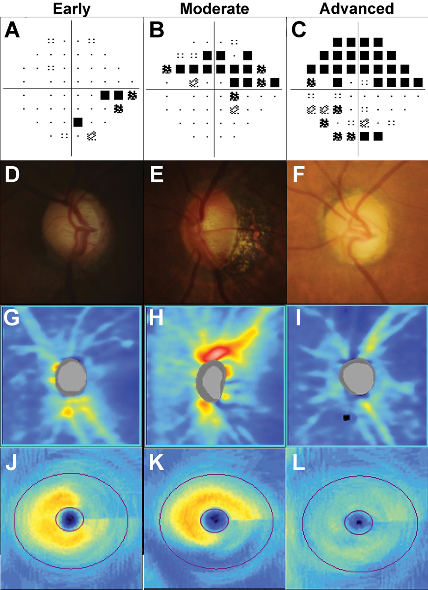 Fig. 7. Examples of early, moderate, and advanced glaucoma staged using visual field severity. In A to C, 24-2 visual field test results: (A) Inferior nasal step in early glaucoma. (B) Superior arcuate defect in moderate glaucoma. (C) Dense superior arcuate defect with an inferior cluster of reduction in advanced glaucoma.  In D to F, disc photographs: (D) Thin superior neuroretinal rim in early glaucoma, (E) Marking loss of the inferior neuroretinal rim with a disc hemorrhage at the inferior disc. (F) Generalized concentric loss of the neuroretinal rim. In G to I, OCT RNFL heat maps: (G) Superotemporal loss of the RNFL. (H) Deep inferior loss of the RNFL. (I) Supertemporal and inferotemporal loss of the RNFL.  In J to L, OCT ganglion cell analysis heat maps: (J) Superior arcuate wedge-like loss. (K) Wide inferior arcuate loss. (L) Generalized loss of the ganglion cell-inner plexiform layer.