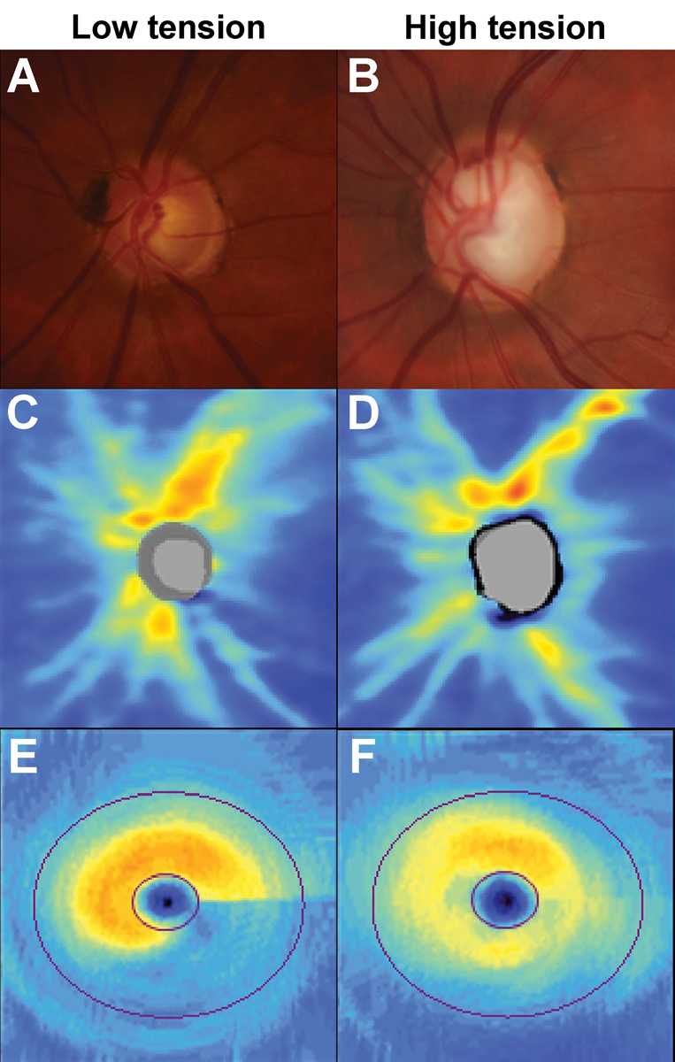 Fig. 8. Examples showing the patterns of loss in low- and high-tension glaucoma phenotypes. (A) Inferior neuroretinal rim thinning in a patient with pre-treatment intraocular pressures of 15mm Hg. (B) Neuroretinal rim thinning affecting the superotemporal, temporal and inferotemporal sectors in a patient with pre-treatment intraocular pressures of 47mm Hg. (C) OCT RNFL heat map shows deep but focal inferior loss in the low-tension phenotype. (D) OCT RNFL heat map shows diffuse but shallower loss in the high-tension phenotype. (E) Deep inferior arcuate loss in the OCT ganglion cell analysis heat map in the low-tension phenotype. (F) The heat map shows generalized but shallower loss is observed in the high-tension phenotype.
