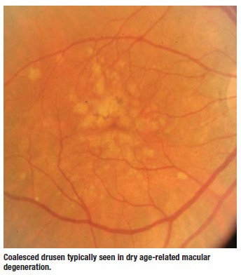 Coalesced drusen typically seen in dry age-related macular
degeneration.